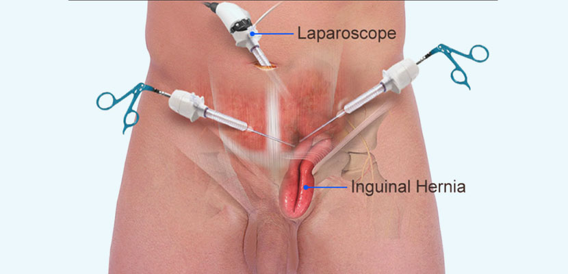 http://www.gastrosurgeonindia.com/wp-content/uploads/2020/12/Laparoscopic-Vs.-Open-Hernia-Repair.jpg